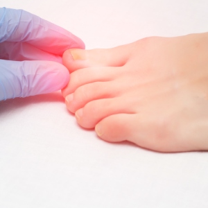 Athlete’s Foot/Fungus Treatment in McDonough, Buford, Norcross, Winder, Flowery Branch, and Conyers, GA