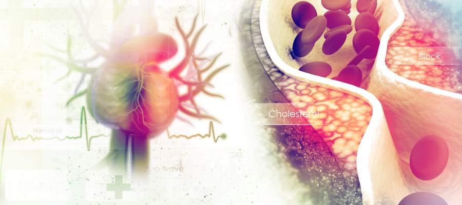 Hyperlipidemia Treatment Clinic in Buford GA