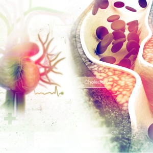 Hyperlipidemia Treatment in McDonough, Buford, Norcross, Winder, Flowery Branch, and Conyers, GA