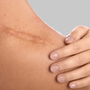 Laceration Repair & Stitches Treatment in McDonough, Buford, Norcross, Winder, Flowery Branch, and Conyers, GA