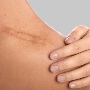 Laceration Repair & Stitches Treatment in McDonough, Buford, Norcross, Winder, Flowery Branch, and Conyers, GA