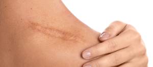 Laceration Repair Clinic for Cuts, Wounds, and Stitches in Flowery Branch GA