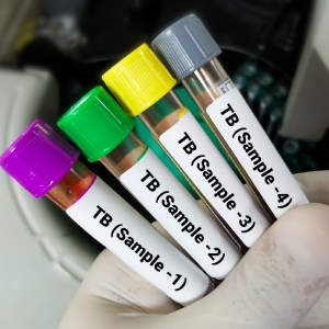 TB Screening in McDonough, Buford, Norcross, Winder, Flowery Branch, and Conyers, GA