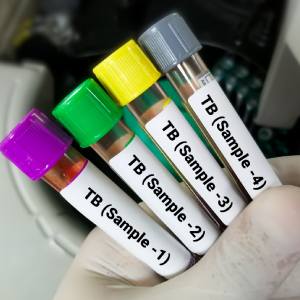 TB Screening in McDonough, Buford, Norcross, Winder, Flowery Branch, and Conyers, GA